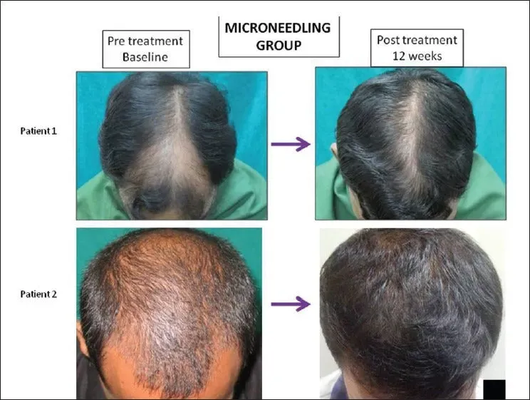 Roller voor micro needling van baard en haar. 2.0 mm. 540 naaldjes. - Afbeelding 2